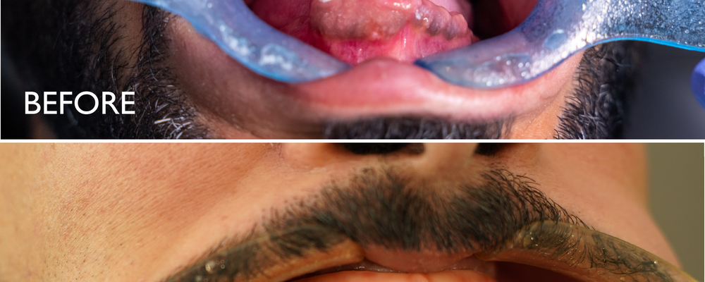 Medcare Dentofaces Doctors Rebuild Jaw And Smile Of An Emirati Patient After A Severe Car Accident